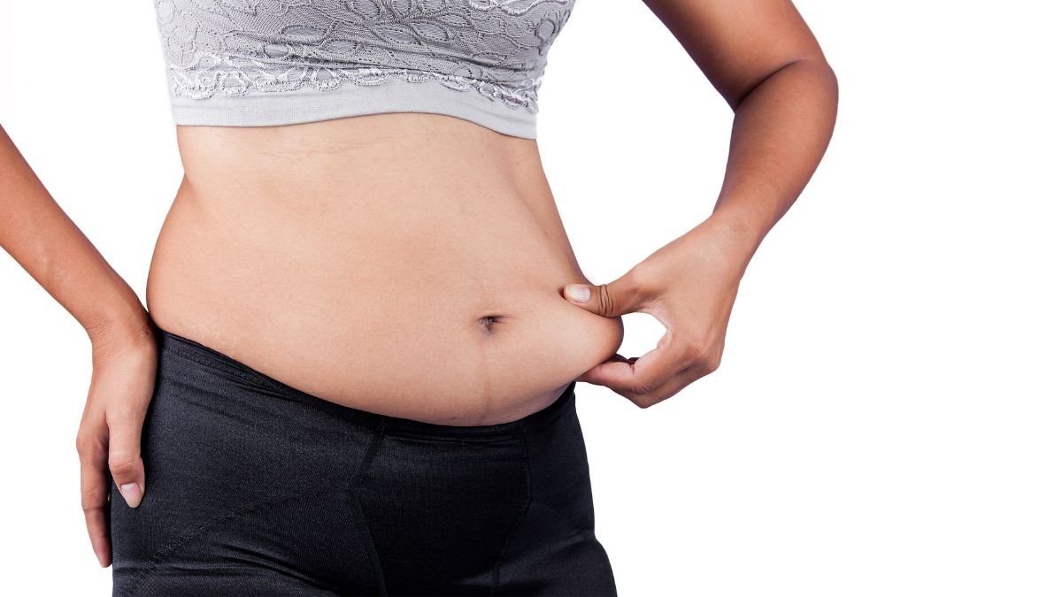 Before Panniculectomy