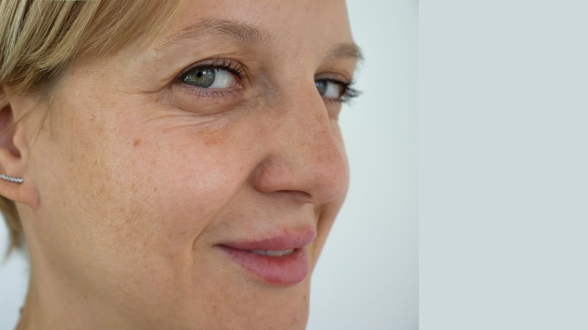 Botox Before