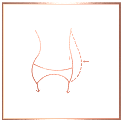Panniculectomy