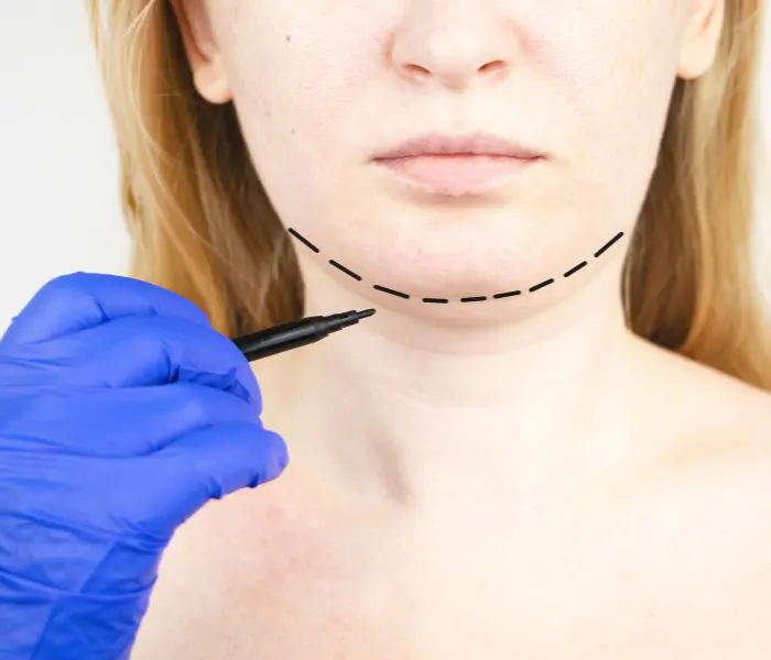 Neck Lift Surgery In Tijuana